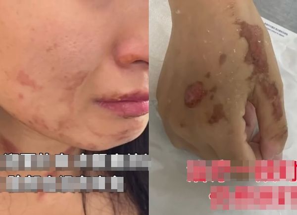 高级餐厅在明火上喷酒精 中国女子全身着火惨被毁容