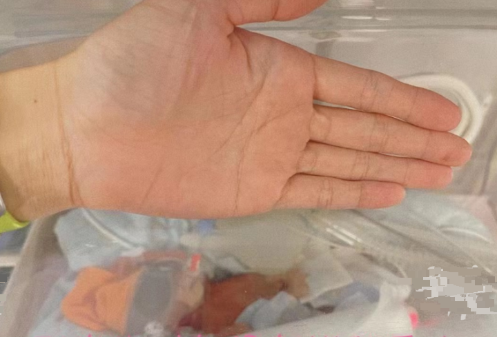 出生时仅成人巴掌大　超早产男婴健康出院