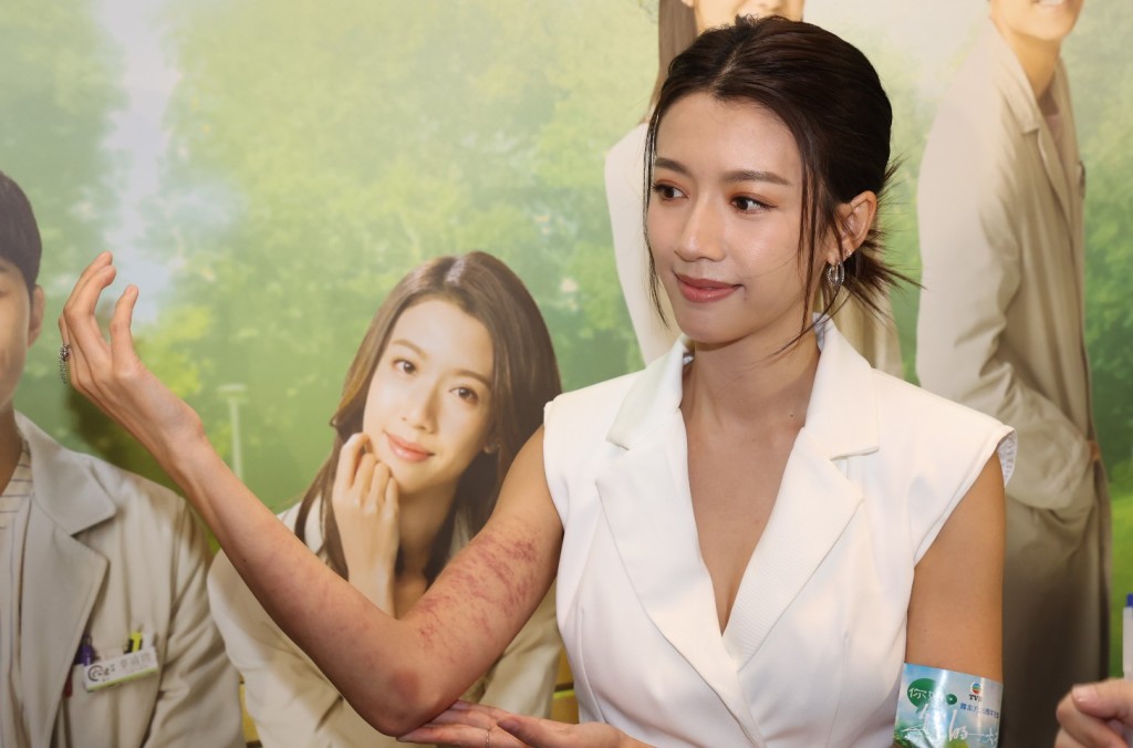 蔡思贝喜获封“美惨强” 撞伤手筋移位惊现大片瘀伤