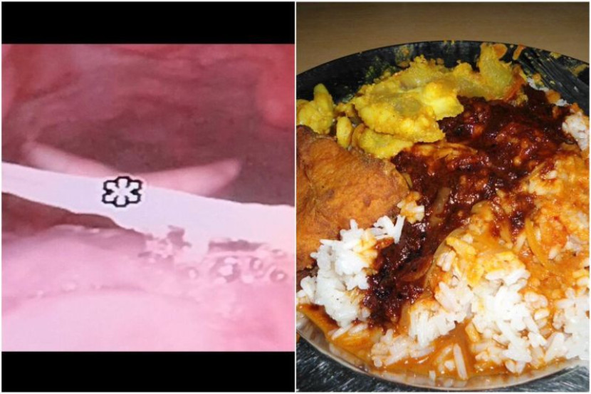 鱼刺卡喉咙太难受 男子:吃香蕉、吞饭都不行