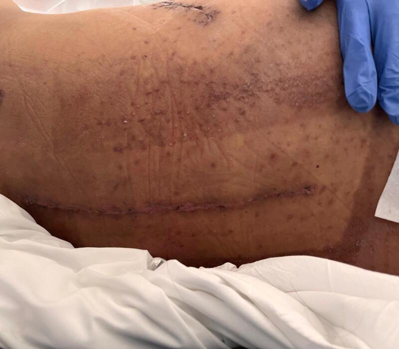 (已签发)柔:狮城二三事:大马厨师狮城遭车碾重伤 雇主助付医药费