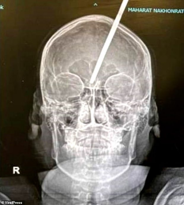 少年河边捕鱼出意外 30公分鱼叉插入脑门