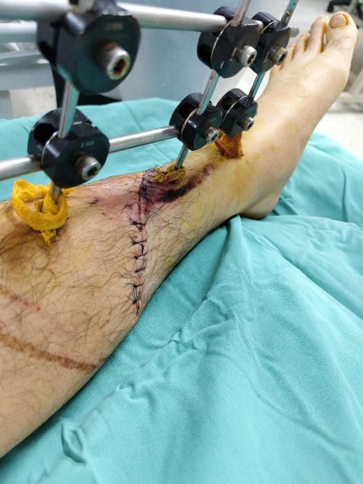 父亲茶室用餐遭撞断腿  黄诗棋曝最新伤势