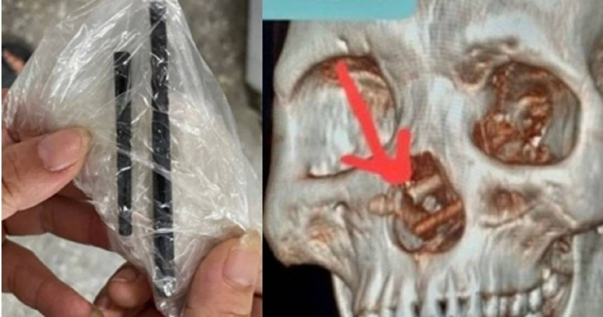 男子头痛鼻水狂流5个月 竟是断筷插脑里