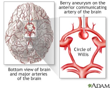 脑动脉瘤破裂致命率高 医生：25%人24小时内死亡