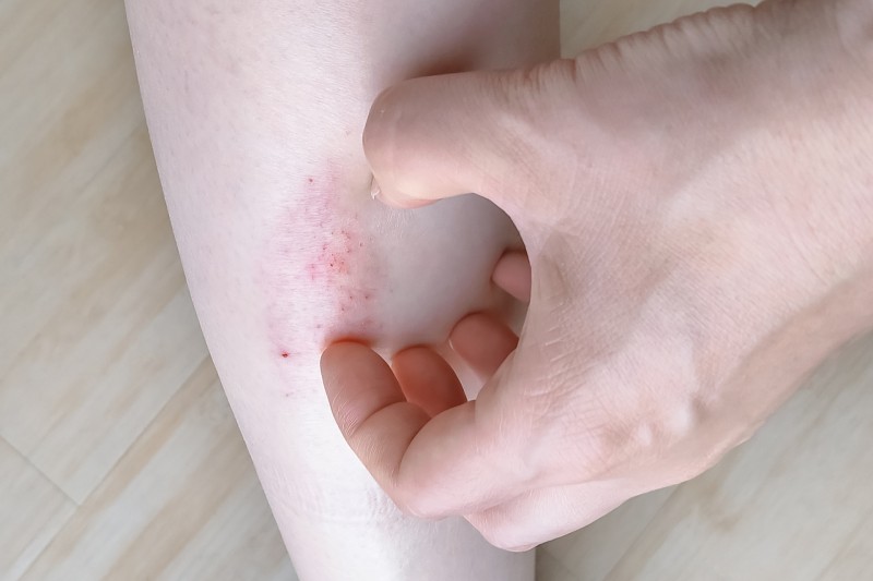 臭虫入侵台北旅馆　观光传播局派员调查 