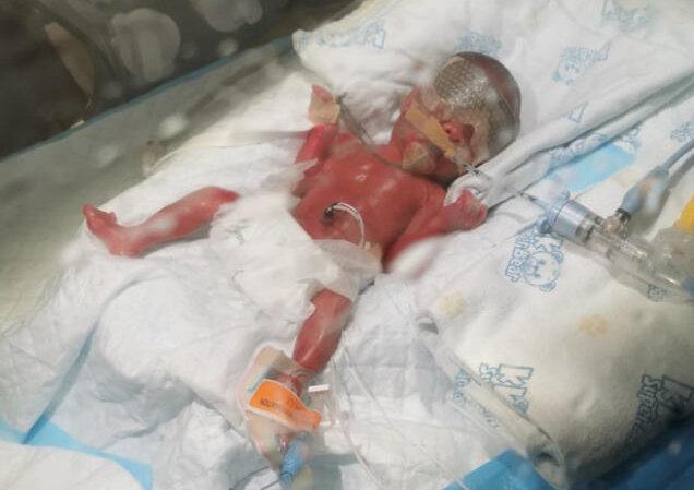 （已签发）柔：狮城二三事：美发师诞早产儿　急筹115万医药费