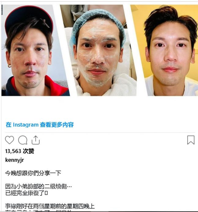 关智斌家中漏煤气点火 脸部二级烧伤险毁容