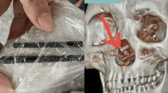 拼盘)男子头痛多月就诊惊揭颅骨藏筷子 成因更疯狂