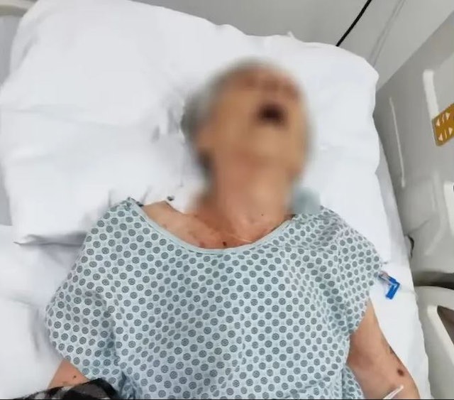 火葬场职员到院收尸　一摸发现老妇尚有体温　困尸袋两小时焗死