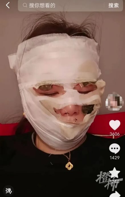 视频|出嫁当天遭喷雾彩带烫伤 女子:做回新娘却险毁容