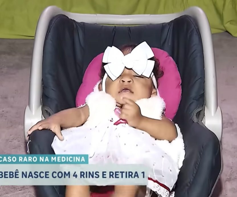 女婴天生有4颗肾 全球不到100例