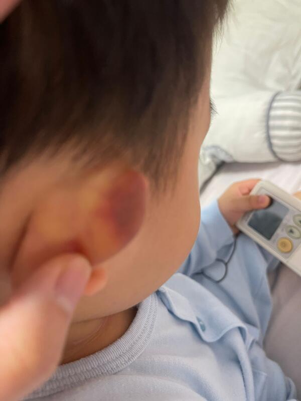 *已签发*柔:狮城二三事:男童进幼儿园第4天 耳有瘀伤父母报警
