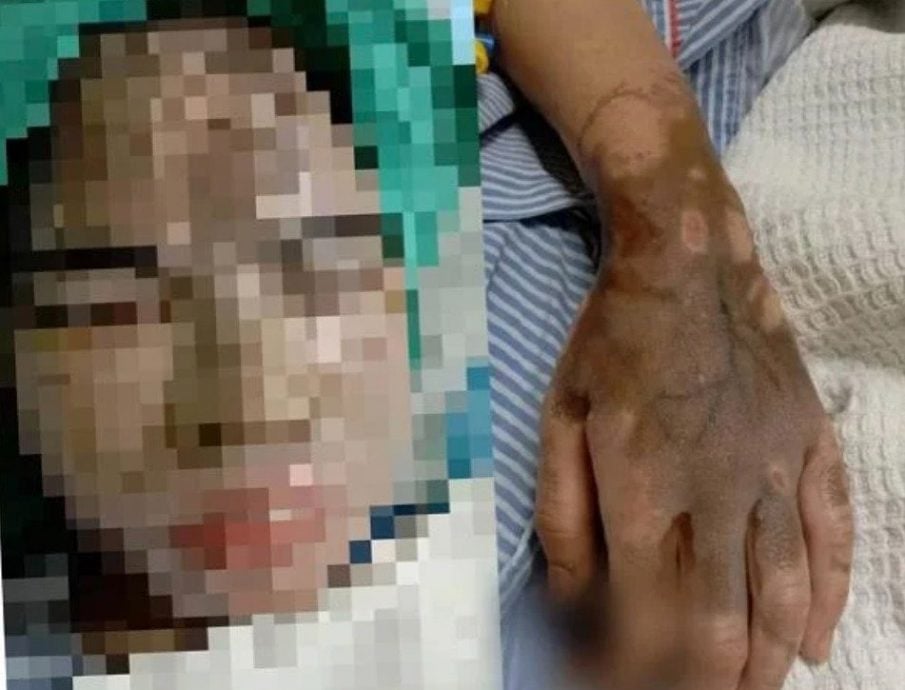 被人泼硫酸皮肤眼睛灼伤70%!少女筹到3万 可动第9次手术了