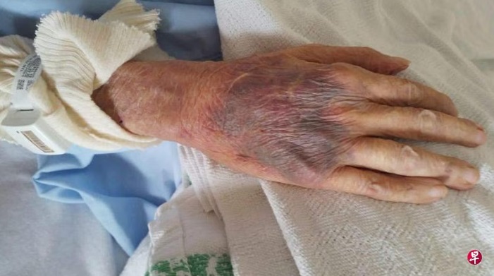 (已签发)柔:狮城二三事:女子申诉:八旬父抽血手瘀青 直至过世尚未散