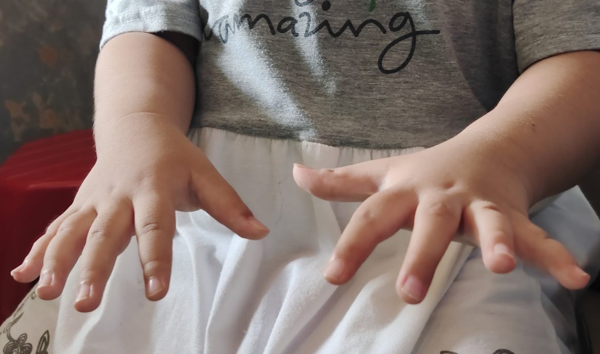 (需转载)NS封底主文/妻女患先天疾病,夫轮椅代步,三口之家“同病相怜”,星洲基金会助筹6万援助金