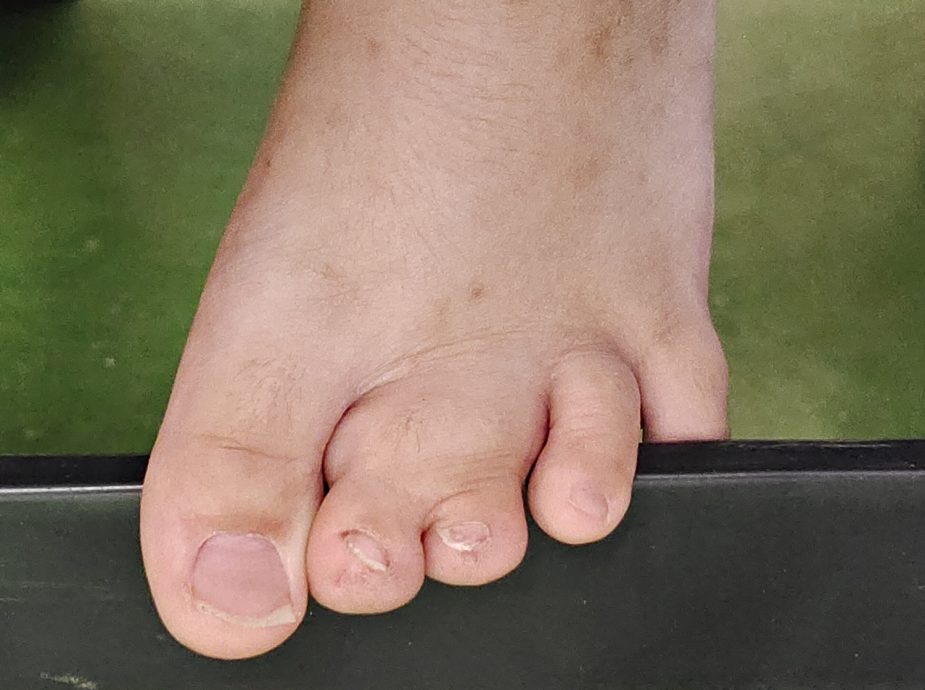 (需转载)NS封底主文/妻女患先天疾病,夫轮椅代步,三口之家“同病相怜”,星洲基金会助筹6万援助金