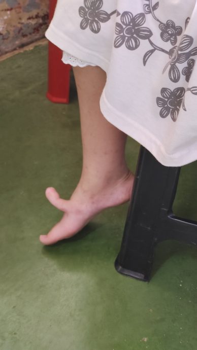 (需转载)NS封底主文/妻女患先天疾病,夫轮椅代步,三口之家“同病相怜”,星洲基金会助筹6万援助金