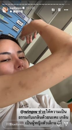 BL剧男星Pawin遭控家暴 女友​腿被打断窒息送医