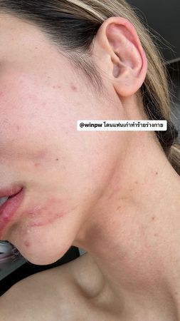 BL剧男星Pawin遭控家暴 女友​腿被打断窒息送医