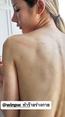 BL剧男星Pawin遭控家暴 女友​腿被打断窒息送医