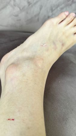 BL剧男星Pawin遭控家暴 女友​腿被打断窒息送医