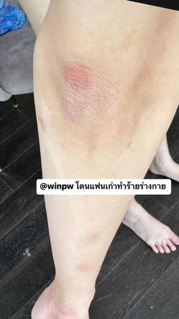 BL剧男星Pawin遭控家暴 女友​腿被打断窒息送医