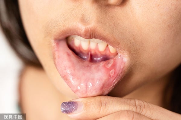 反复嘴破以为上火 20多岁女研究生一查“罹癌”　