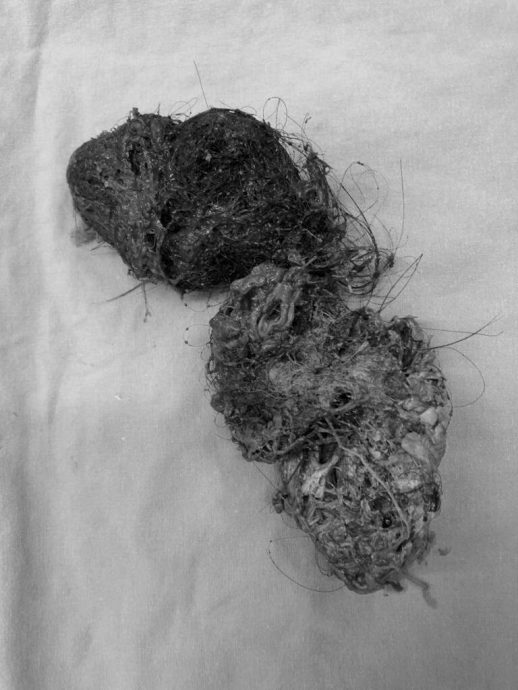 发丝与食物纠缠打结 女童吃头发腹痛半年