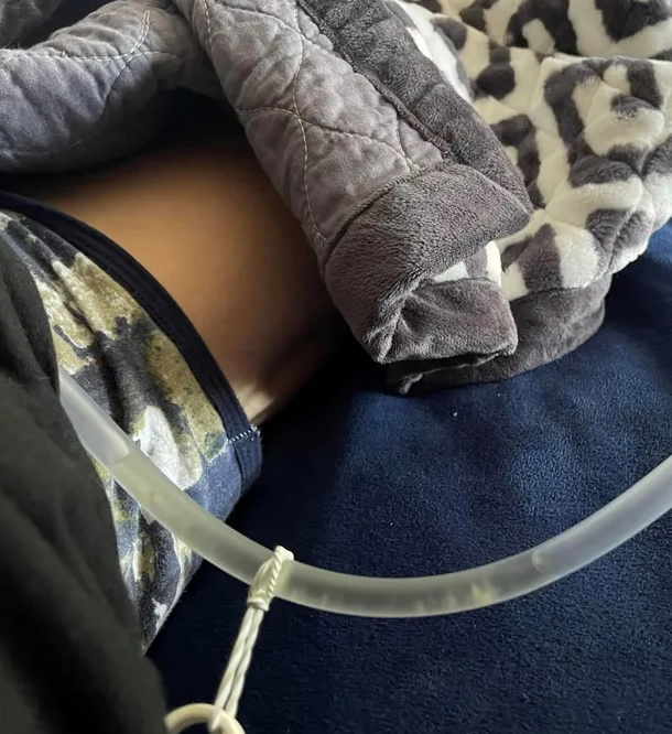 孙德荣尿不出紧急开刀 “别集气！上天让我活我就活”