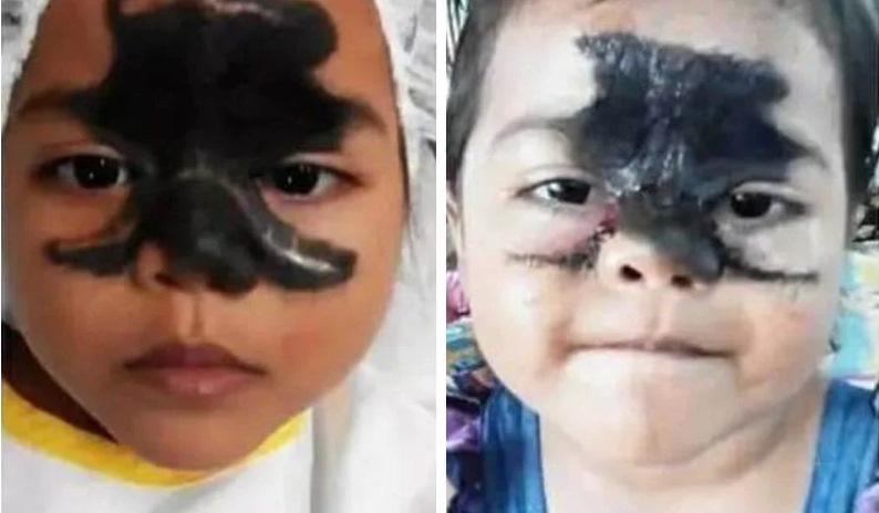 **已签发**柔：社媒分享女儿脸上胎记照，母：鼓励接受不完美