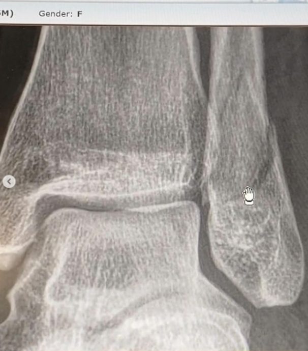 林佩琦摔伤左脚骨折 注入钢钉留4公分疤