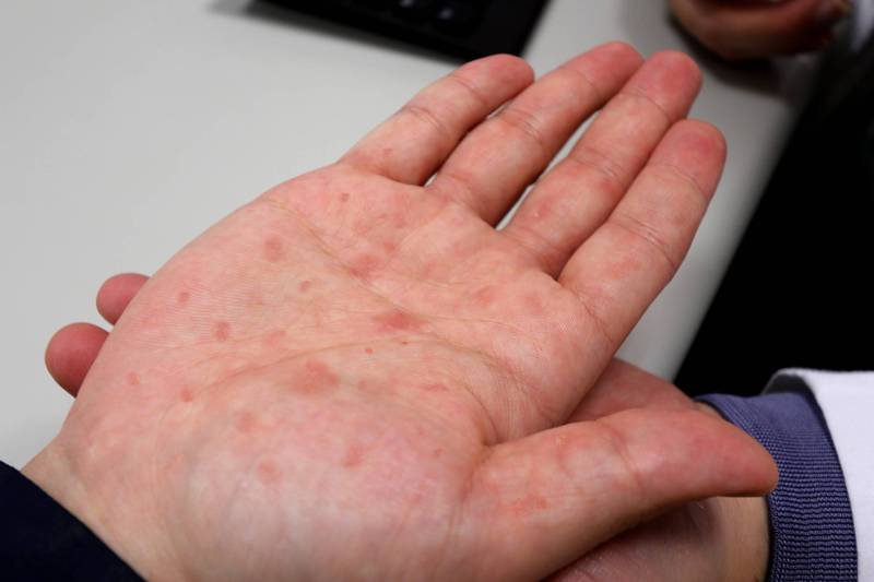 梅毒病例破1950年来新高 美国异性恋中标变多了