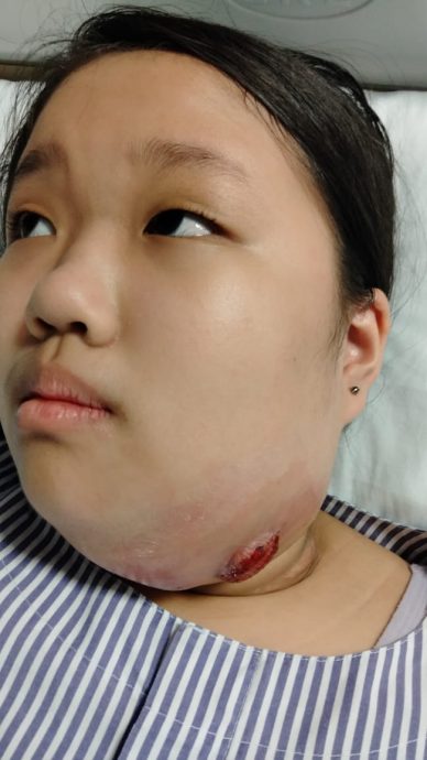 汤紫琳二度复发淋巴癌 星洲基金助筹6万医药费