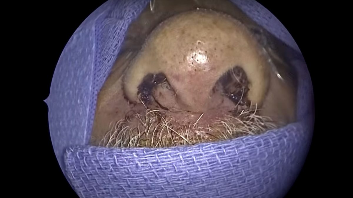 男狂流鼻血嘴唇莫名肿起来　医生从他鼻子吸出150只活虫