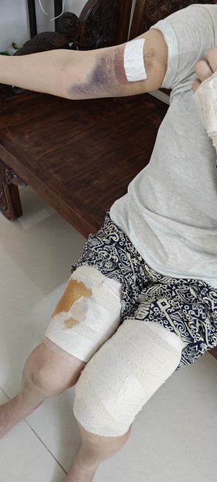 （大北马）华裔妇女被3恶犬噬咬，过年每天折返医院洗伤口