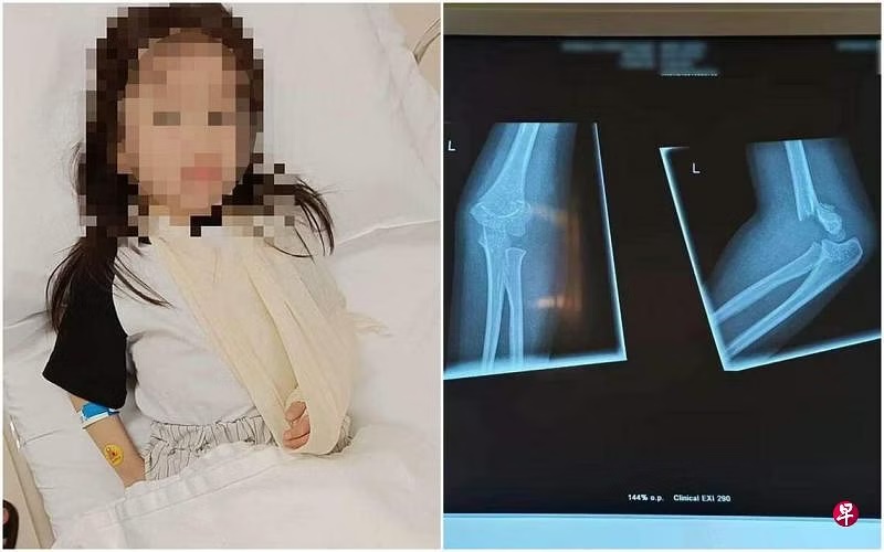 (已签发)柔:狮城二三事:女童被绊倒骨折 涉事妇女道歉愿赔3500元