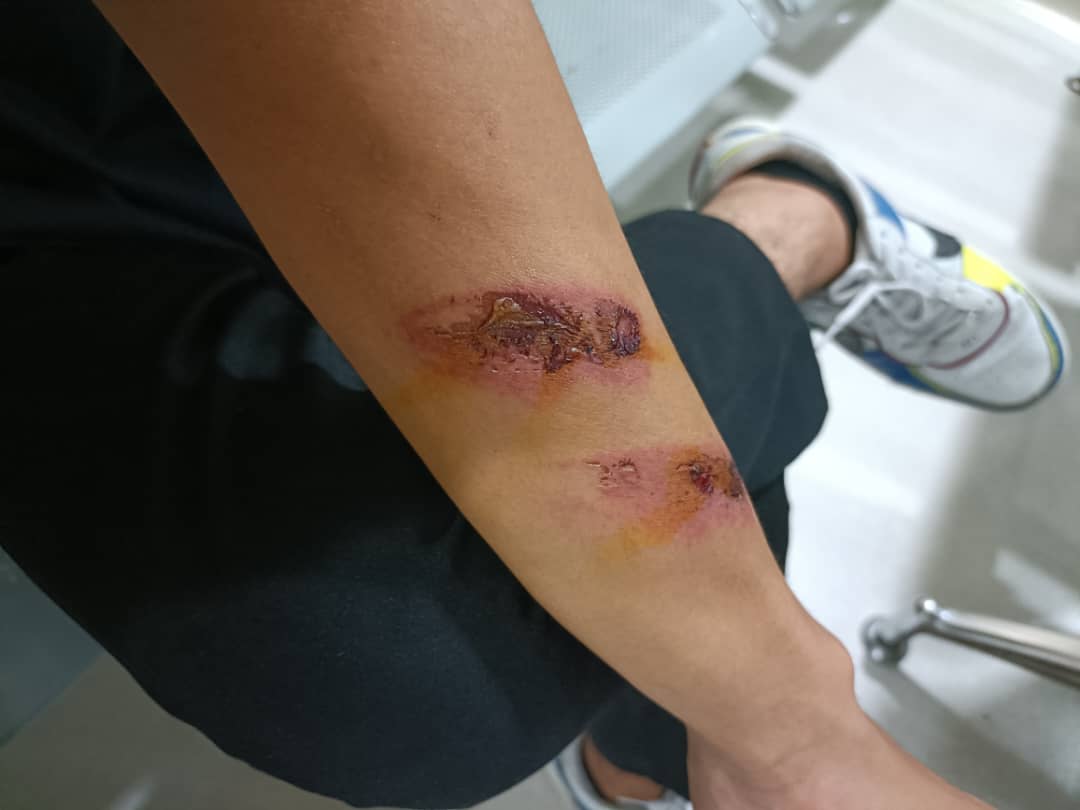 东:疑未参加息礼被惩罚,技职学院学生控诉遭老师鞭打身体多处受伤。