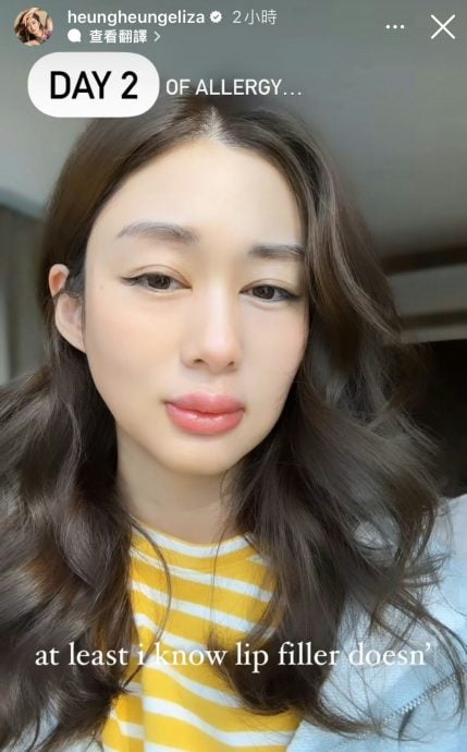 岑丽香过敏变“孖润肠” 自嘲像《东成西就》梁朝伟