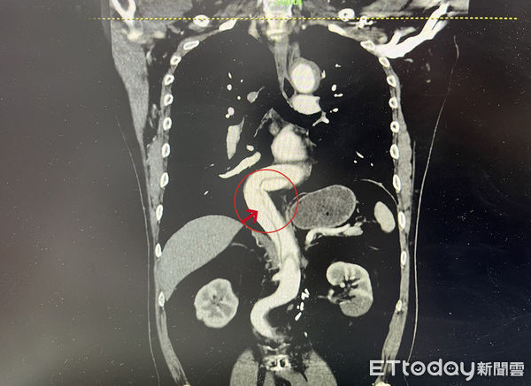 打个大喷嚏男子“主动脉破裂逾40公分”医生惊:超罕见