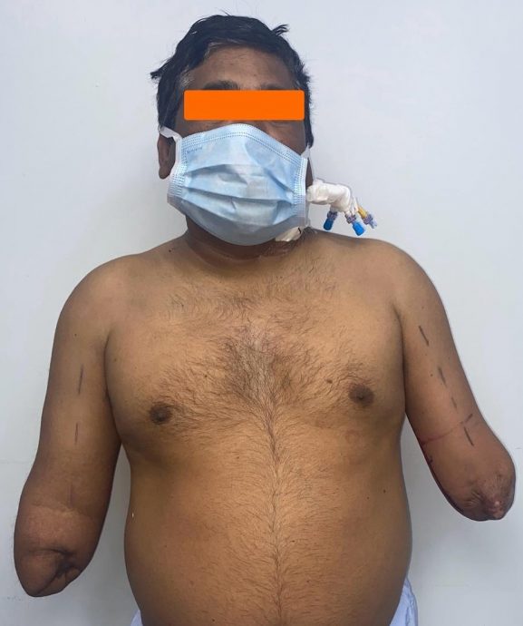 男遭火车撞上断手 等4年终等到“双臂器捐”12小时手术接回