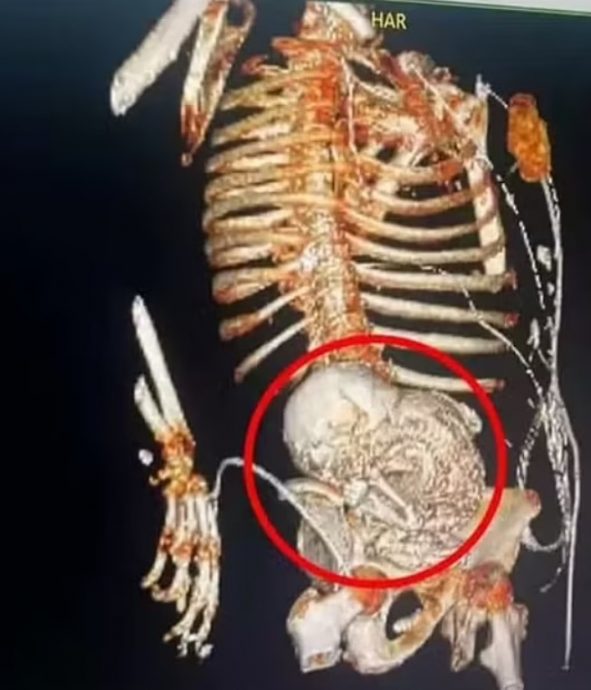 胎死腹中56年 81岁奶奶肚痛就医“惊见石胎