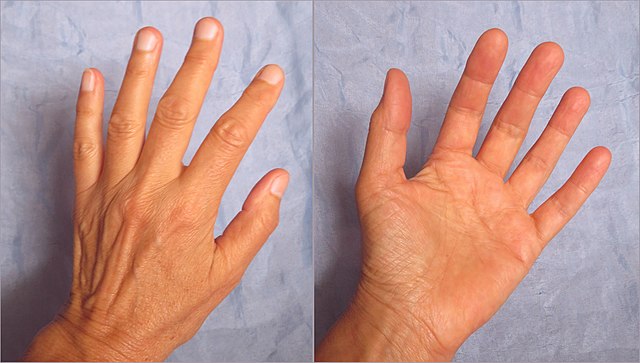 致死率高达30% 日本毒性休克症候群案例激增 原因成谜