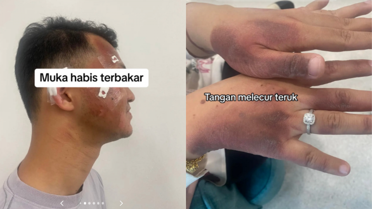 视频 | 吃火锅煤气炉爆炸！一家7口严重烧伤一人须整容