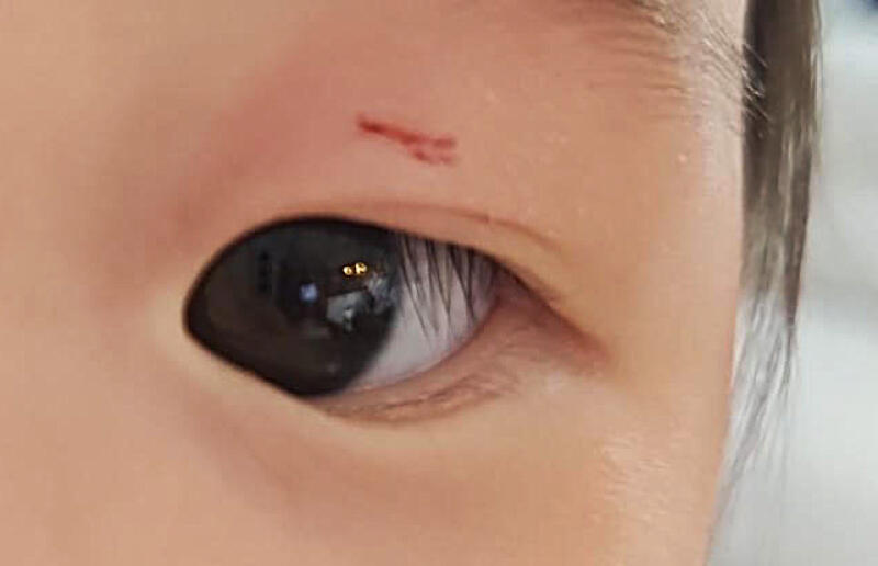 (已签发)狮城二三事:双胞胎女儿被咬伤 家长报警追究