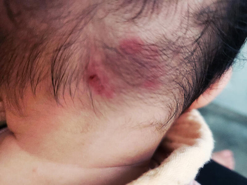 (已签发)狮城二三事:双胞胎女儿被咬伤 家长报警追究