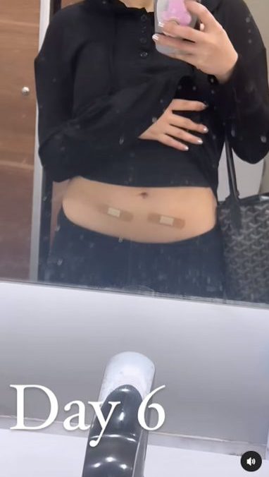 JW王灏儿自曝冻卵过程 10天打21支排卵针:值得