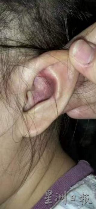 女童被掌掴打伤脸,母亲男友落网 认了动手