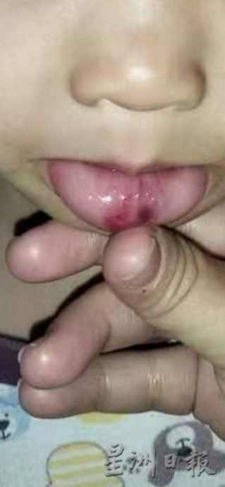 女童被掌掴打伤脸,母亲男友落网 认了动手