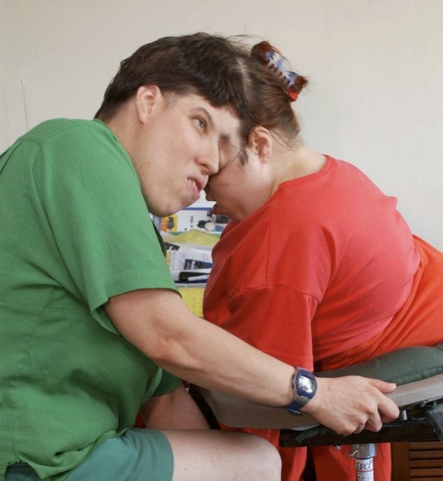 拚图已签)全球最年长连体双胞胎62岁过世 比医生预测多活30余年